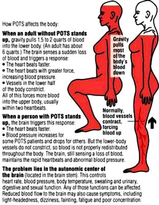 POTS and EDS: Improving resources for Postural Orthostatic Tachycardia  Syndrome and Ehlers-Danlos Syndrome Patients